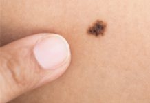 Câncer de pele o maior inimigo dos brasileiros