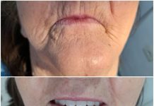 Prótese Dentária Fixa: o que são e seus diferentes tipos