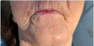 Prótese Dentária Fixa: o que são e seus diferentes tipos