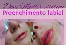 Preenchimento labial
