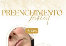 PREENCHIMENTO LABIAL